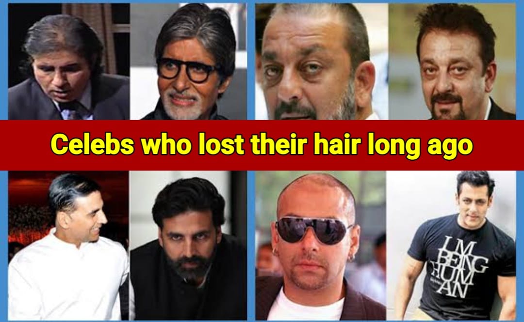 10 Indian stars who lost their hair, now using artificial techniques to cover it