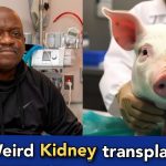 Man receives Pig's kidney, dies after 2 months